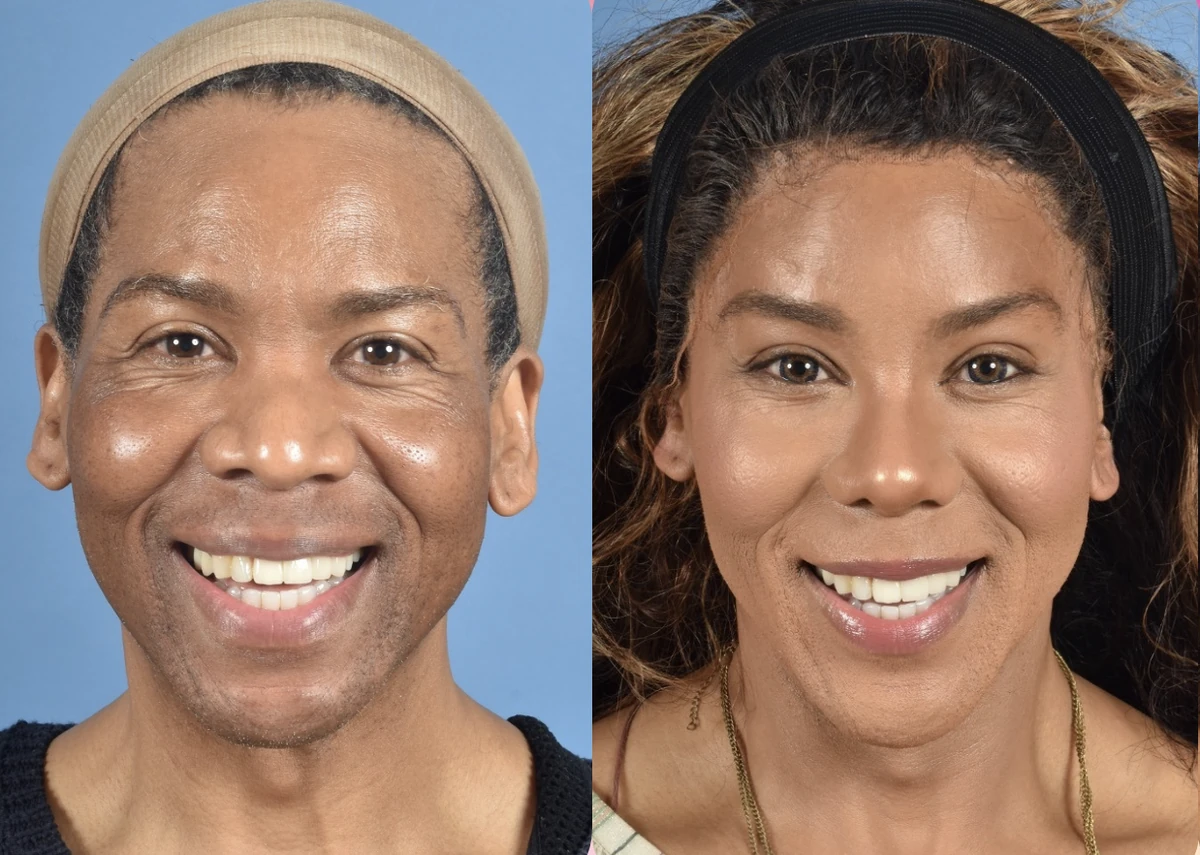 Two facial feminization surgery patient portraits