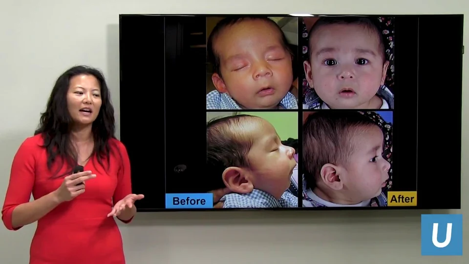Dr. Justine Lee presenting Pierre Robin sequence